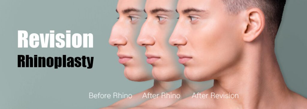 Rhinoplasty in Iran | Revision Rhinoplasty