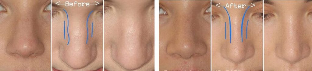 Rhinoplasty Swelling Timeline But Mag 