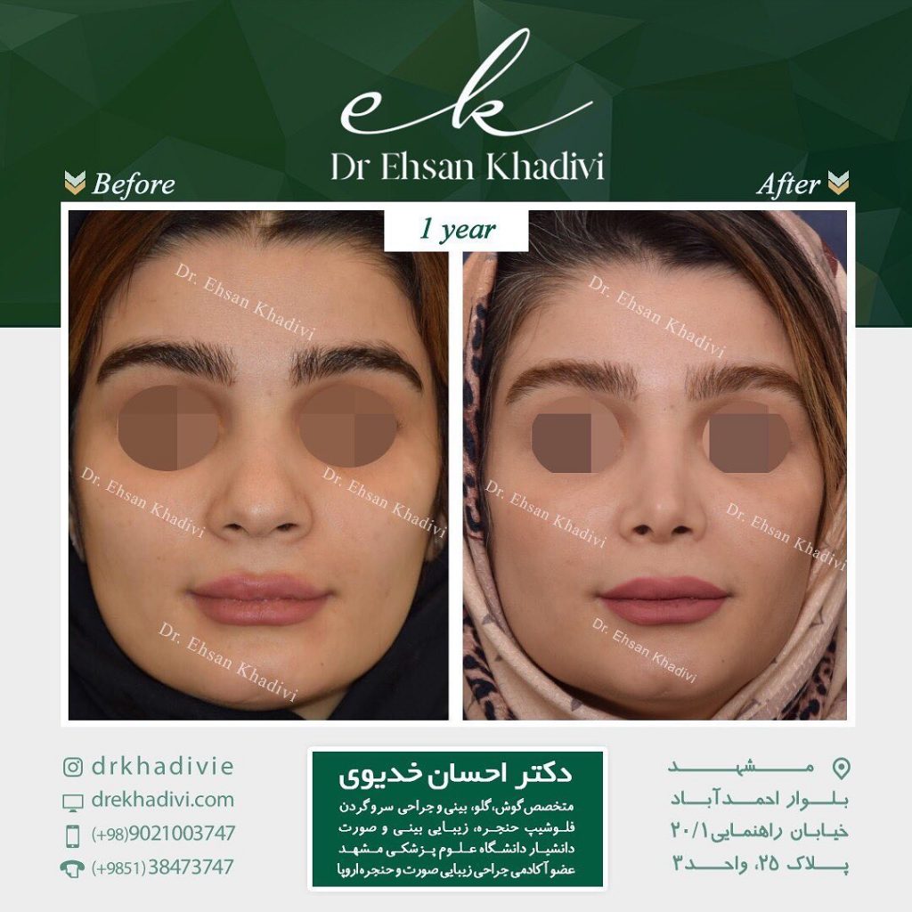 Dr.Khadivie nose job iran