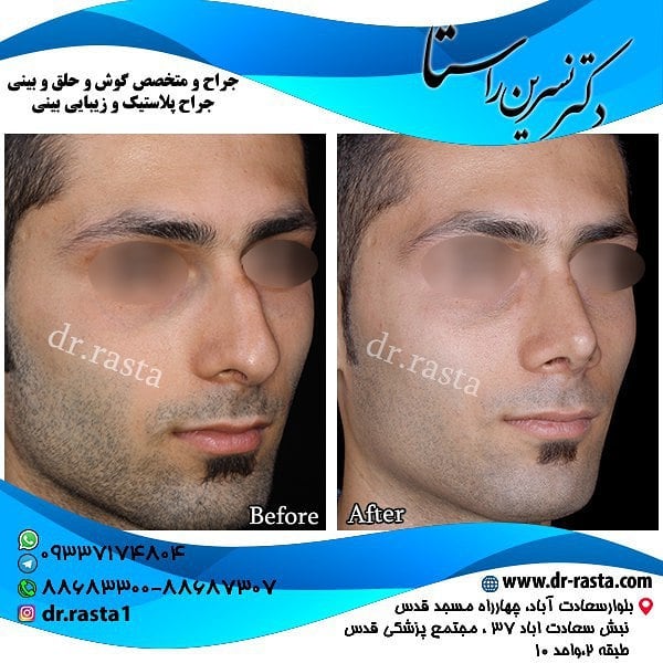 Skin Care Consultation after rhinoplasty