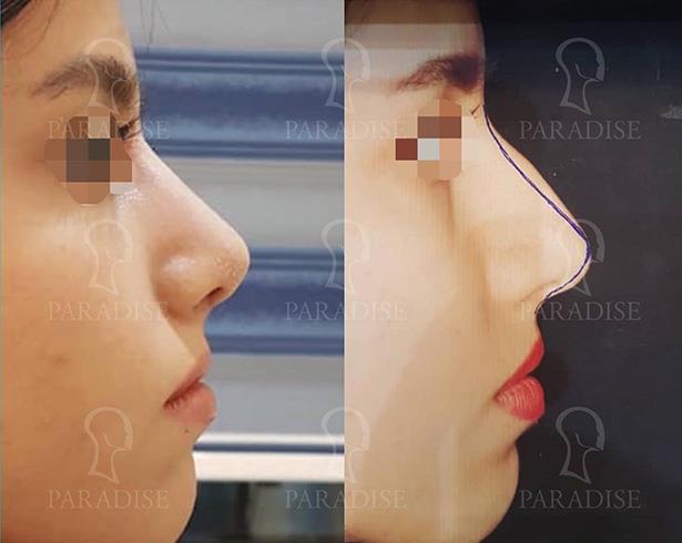 tip plasty Dr. ganjehkhosravi nose job