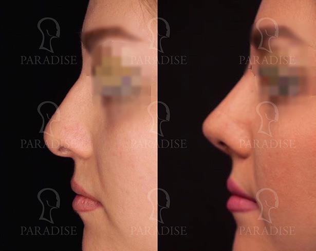 tip plasty Dr. ganjehkhosravi nose job