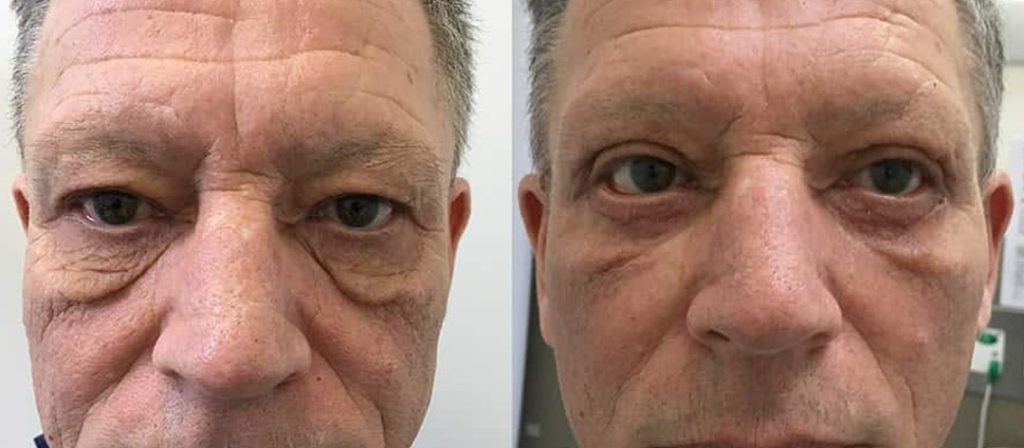 Who is a Good Candidate for blepharoplasty? 
