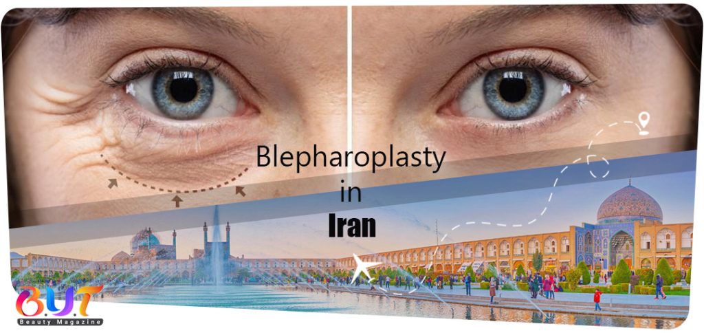 Eyelid surgery or blepharoplasty in IRAN | costs and recommendations