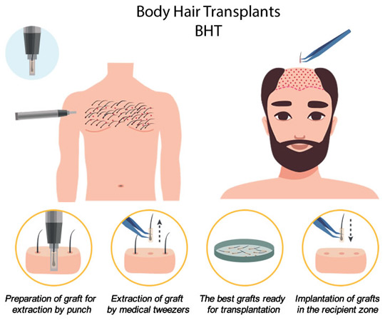 What is BHT hair transplant? Cost, steps and care