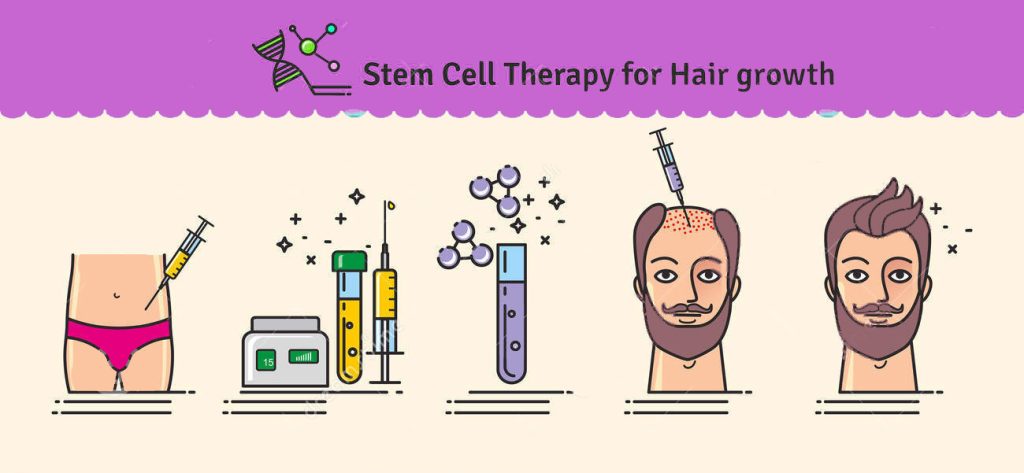 Stem cell hair transplantation 2022 |Costs and benefits