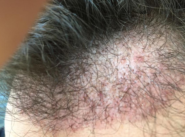 Folliculitis after hair transplant | Cause and treatment