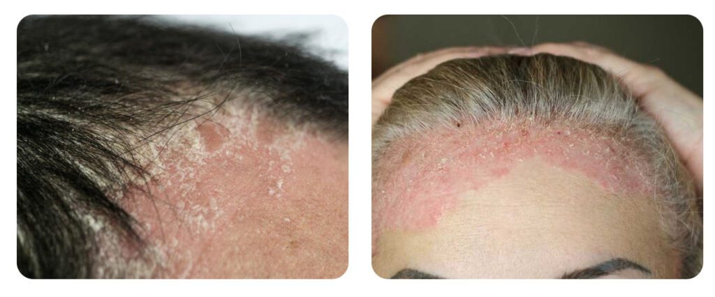 Can psoriasis patients do hair transplant?